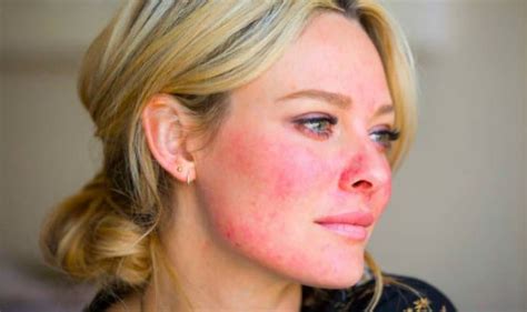 Rosacea rozaceja zašto nastaje i kako se liječi MaminSvijet hr