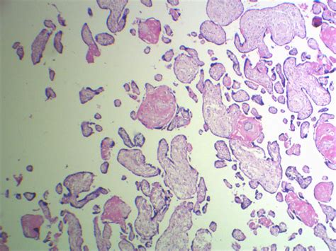 Pathology Outlines Mesenchymal Dysplasia