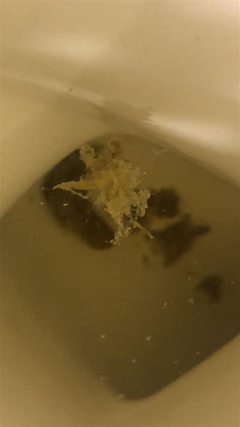 White Fluffy Mucus In Stool