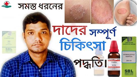 দাদের সম্পূর্ণ হোমিওপ্যাথি চিকিৎসা Ringworm Fungal Infection