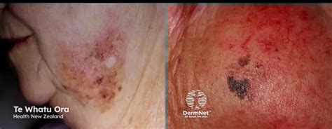 Lentigo Maligna Melanoma Prognosis Treatments And Risk Factors