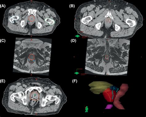 Prostate SBRT | Radiology Key