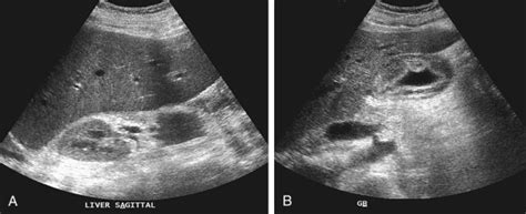 Liver Glycogen Storage Disease Ultrasound