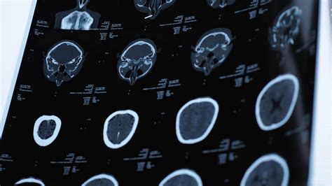 Magnetic Resonance Imaging Of An Older Man S Brain After A Traumatic