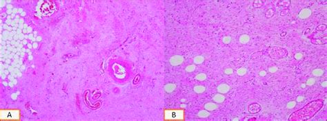 The Tumor Has Infiltrative Margins And Non Neoplastic Soft Tissue In