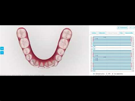 Planificación digital Invisalign YouTube