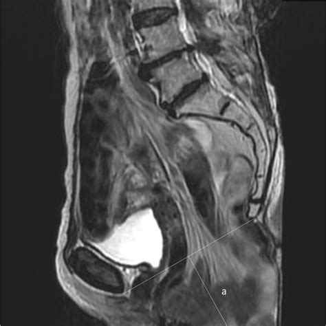 Surgical Steps Of Vertical Rectus Abdominis Myocutaneous VRAM Flap