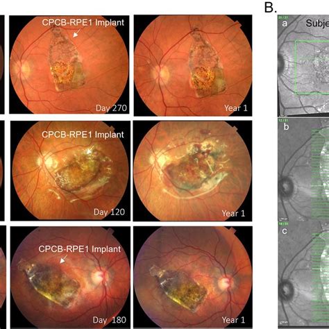 The Cpcb Rpe Implant A The Hesc Derived Rpe Cells Seeded And