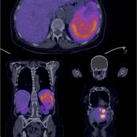 CT PET DOTATATE Scan Demonstrating Avidity Of The Pancreatic Tail Mass