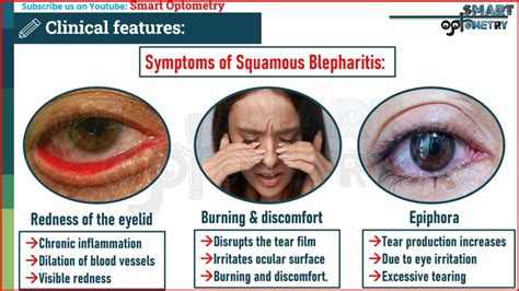 Blepharitis Introduction Causes Symptoms Signs Treatment And Complications Smart Optometry