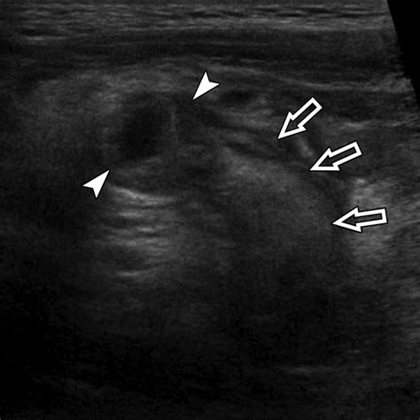 Ultrasound Imaging Of Bowel Pathology Technique And Keys To Diagnosis