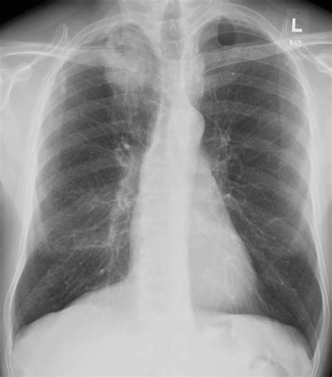 vg  lungs  apex mass cavitation ddx necrotizing mssa cxr frontal