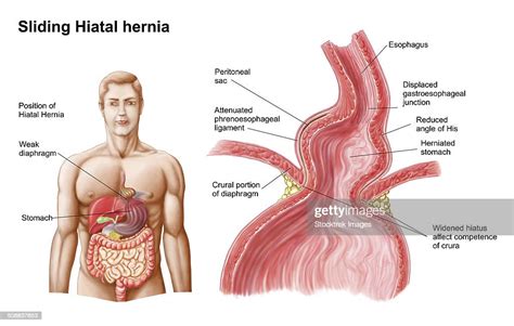 Medical Ilustration Of A Hiatal Hernia In The Upper Part Of The Stomach