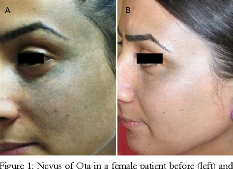 Successful Treatment Of Ota Nevus With The 532 Nm 58 Off