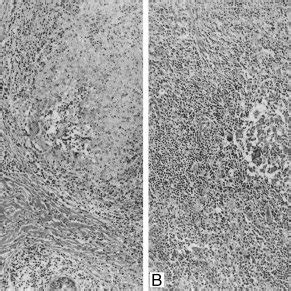 Two More Cases Of Idiopathic Granulomatous Mastitis A Displaying A