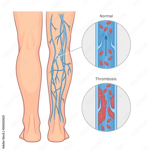 Deep Vein Thrombosis Stock Vector Illustration Of Valves Hot Sex Picture