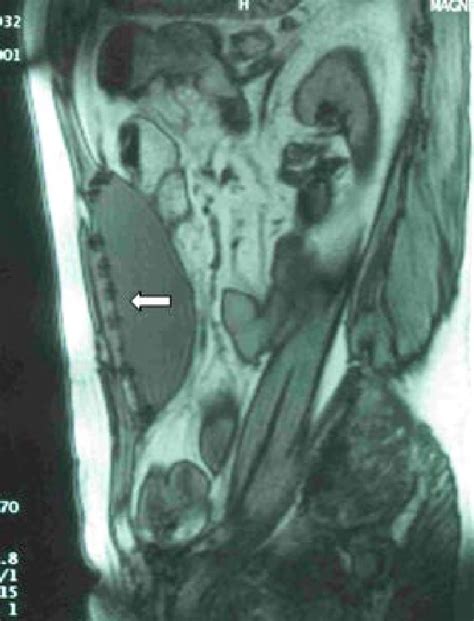 One Month Postoperative Sagittal Mri Control After Laparoscopic