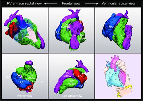 Tetralogy Of Fallot With Left Ventricle On Top Of The Right Ventricle Download Scientific