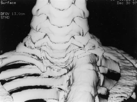 Figure 1 From Anterior Approach To The Cervicothoracic Junction By