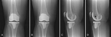 Imaging Of Total Knee Arthroplasty Musculoskeletal Key