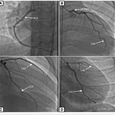 Coronary Angiogram Coronary Arteries Are Patent Without Any