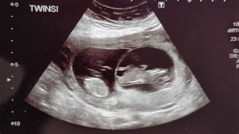 Twin Ultrasound 12 Weeks: Dating & Chorionicity Scan – About Twins