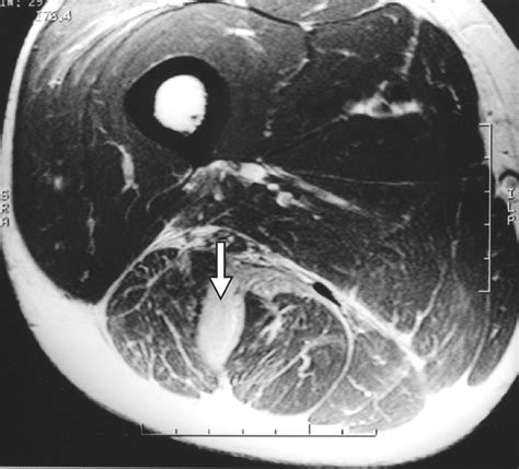 Hamstring Muscle Complex An Imaging Review Radiographics