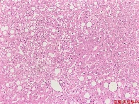 Kmu Pathology Labslide Fatty Liver Liver