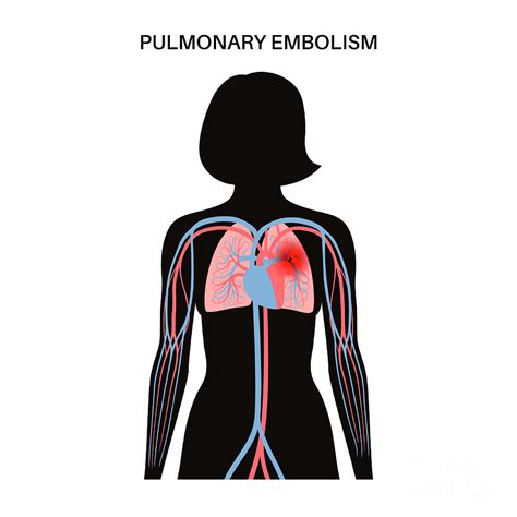 Pulmonary Embolism Photograph By Pikovit Science Photo Library Fine Art America