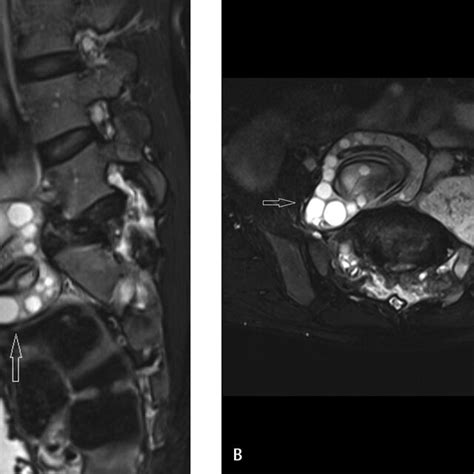 T2 Weighted Fat Suppressed Sagittal A And Axial B Magnetic Download Scientific Diagram