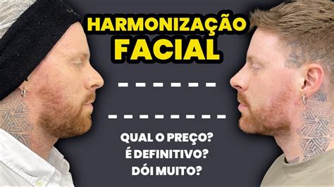 Harmoniza O Facial Masculina Antes E Depois Respondendo D Vidas