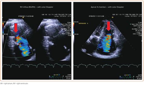 Figure 1 Transthoracic Echocardiogram Showing Severe Tricuspid