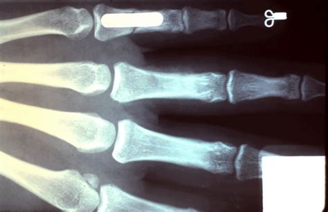 Proximal Phalanx Fracture The Hand Treatment Center New Jerseynew