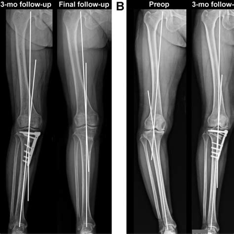 Hip Knee Ankle Hka Angle Measurements By Time For All Patients Blue