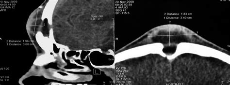 Sagittal A And Axial B Contrast Enhanced Ct Scan Of The Paranasal