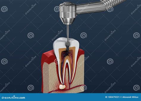 Root Canal Treatment Medical Vector Illustration Isolated On White