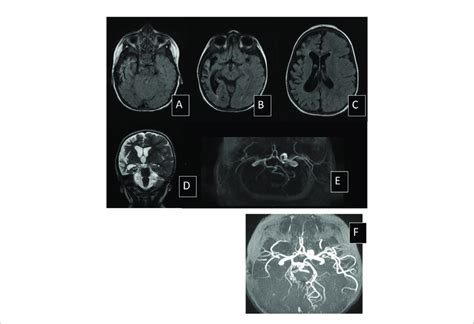 | MRI scan of patient N09, 1 year after stroke secondary to cerebral ...