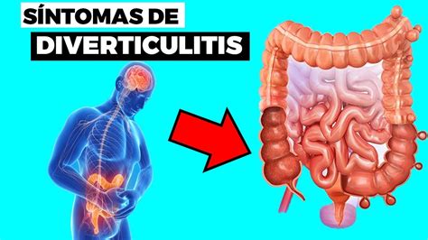 O Que é óstios Diverticulares BRAINCP