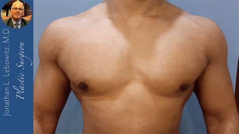 25 Months Post Op Hi Def Gynecomastia Surgery At The Long Island Vaserlipo Center By Dr