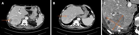 Pancreatic Panniculitis And Elevated Serum Lipase In Metastasized