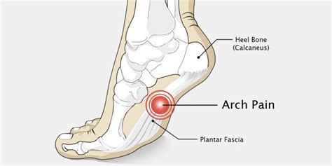 Prevent and Alleviate Foot Arch Pain With These Moves - The Ayurveda