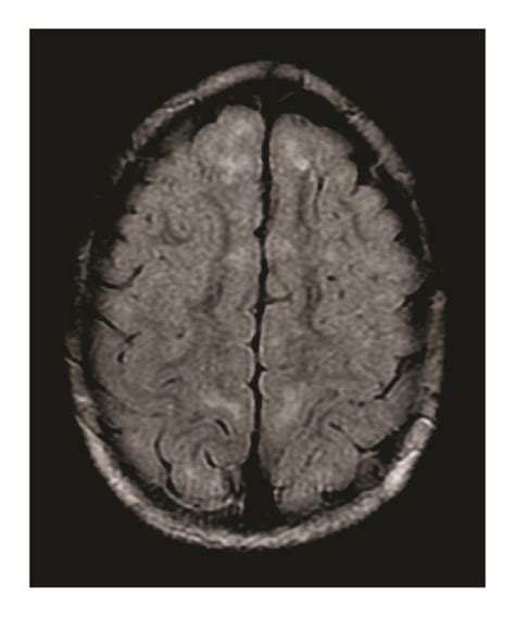 Axial T2 Flair Mri Image Demonstrating Subcortical White Matter Download Scientific Diagram