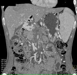 Pancreatic Cancer Encases The Pv Smv With Collaterals Pancreas Case