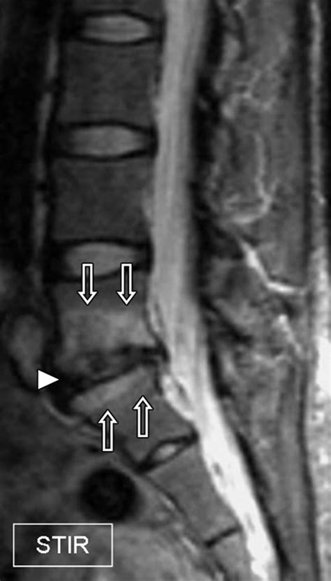 Lumbar Discitis Mri