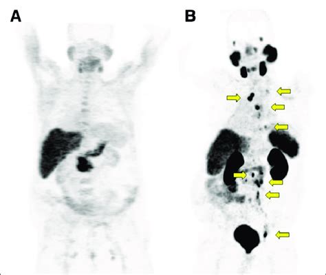 Patient Had Negative F Fluciclovine Pet Ct Results And Positive