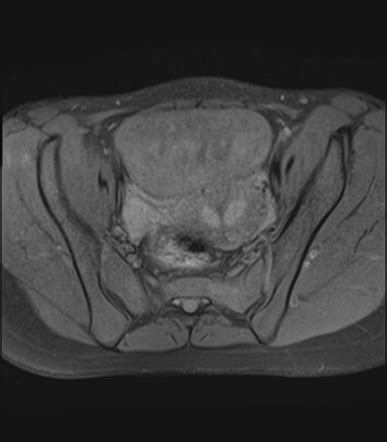 Septate Uterus With Hemorrhagic Ovarian Cyst Image Radiopaedia Org