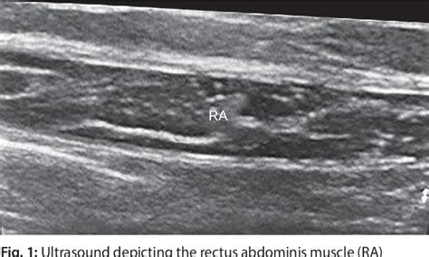 Figure From Evaluation Of Abdominal Expiratory Muscle Thickness