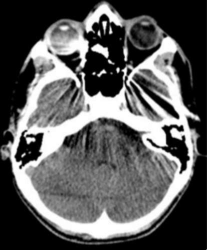 Ct Image Artifact Flashcards Quizlet