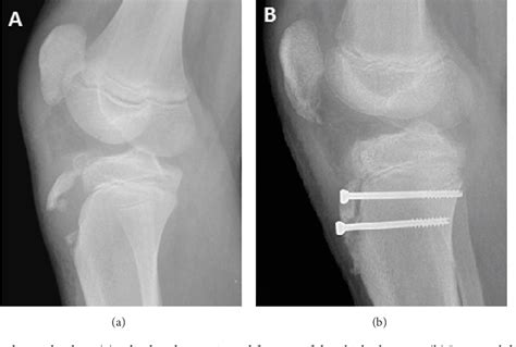 Tibial Tuberosity Fracture