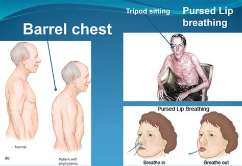 COPD Flashcards Quizlet